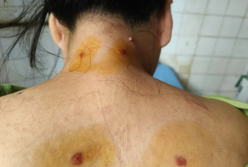 [壮医特色疗法]——水蛭疗法快速缓解21年肩背疼痛